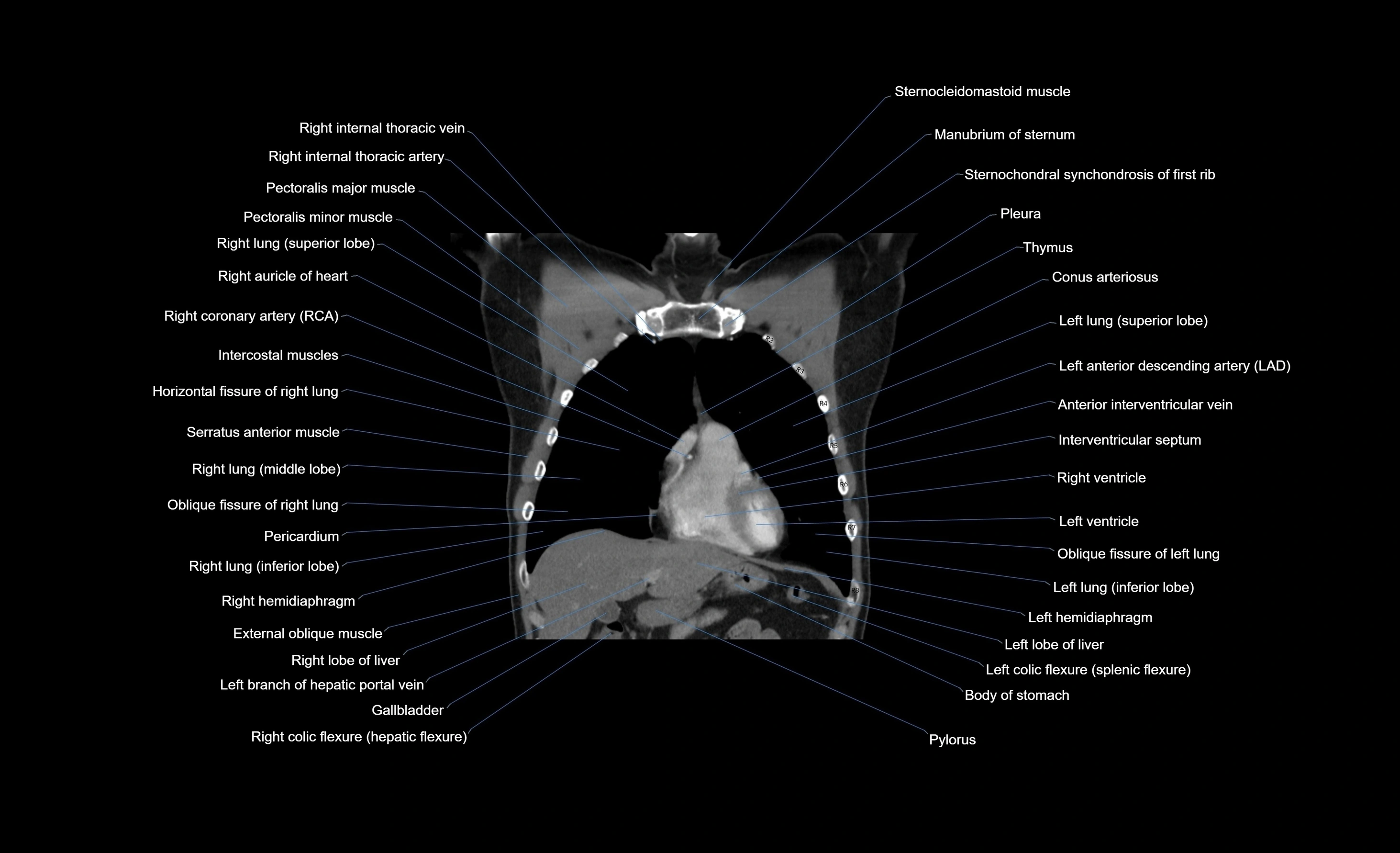 CT chest (thorax) labelled coronal cross sectional anatomy radiology image-00085.webp